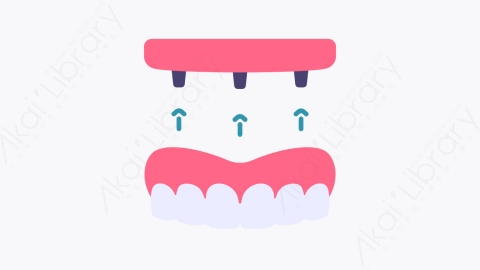 图片素材-025牙种植体 dental implant扁平MG卡通牙科元素图标