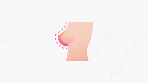 图片素材-006-乳房植入物breast_implant扁平卡通整形外科图标